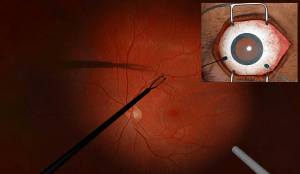 Simulation of a cataract removal surgery, via the software developed by InSimo