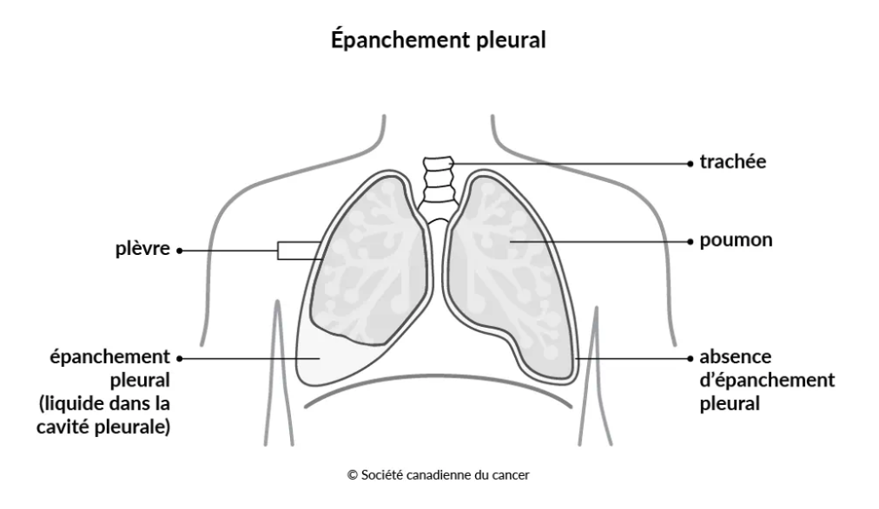 Épanchement pleural