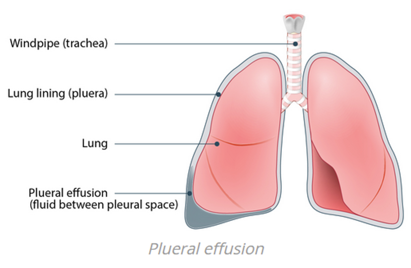 Thoracentesis