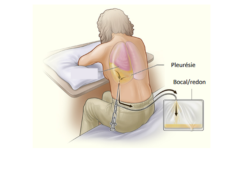 Ponction Pleurale