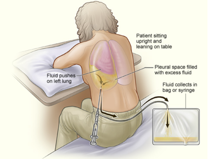 Thoracentesis